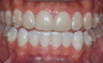 Fig 2. Patient after bleaching mandibular arch nightly for 1 month with clear aligner trays in place, demonstrating the efficacy and safety of bleaching during aligner treatment.