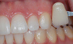 Fig 10. Post-bleaching shade of the maxillary right (Fig 9) and left (Fig 10) canines taken 1 week after removal of the composite buttons demonstrated bleaching occurred under the buttons and throughout each tooth.