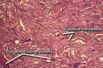 Fig 11. Photomicrograph at higher power showed dense fibrous connective tissue with fusiform fibroblasts and numerous vascular channels.