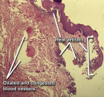 Fig 10. Photomicrograph at medium power demonstrated heat artifact at the surgical margins with numerous dilated and congested vascular channels observed in the superficial connective tissue.