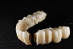 Fig 1. When zirconia fractures, variables such as design, nesting, connectors, milling strategies, mill maintenance, and more can be responsible.