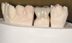 Figure 10  An early MZ molar crown after shaping and polishing.