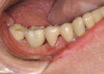 Figure 12  A MZ implant crown cemented over a metal abutment. No metal show-through is seen.