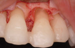 Figure 5  Debrided periodontal defect around tooth No. 9. The hypermobile tooth was provisionally splinted prior to surgery. After open debridement with ultrasonic, rotary, and manual instruments, root conditioning with neutral pH EDTA was performed