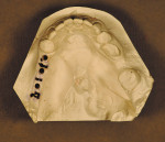 Figure 1  3/32-inch holes were drilled in the cast after marking the distances between the centers of the teeth on the ridge.