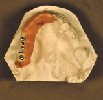 Figure 3  View of the diagnostic template in place on the cast, ready for placement in the patient?s mouth for scanning.