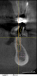 Figure 4  A compound bend was necessary in two planes to correct the implant placement. Angles are measured with software or a protractor and used to make the correction.