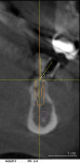 Figure 6  The x-ray of site No. 19 indicated a single bend was needed. A 33? correction was required to correct the bucco-lingual angle of the middle guide sleeve.