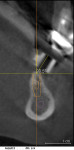 Figure 9  The x-ray of site No. 18 indicated a 30? single bend was needed to change the bucco-lingual angle of the guide sleeve.