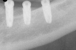 Figure 13  A final periapical x-ray was taken after the implant was placed.
