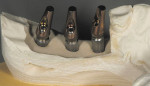 Figure 14  Three-angled abutments were used to restore the case: Nos. 18 and 19, 25? abutments; No. 20, 15? abutment.