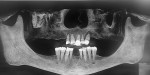 Pretreatment radiograph of the patient showing remaining maxillary teeth demonstrating bone loss and periapical pathology and missing mandibular central incisors.