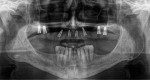 Posttreatment radiograph taken 5 months after bilateral sinus augmentation and placement of
implants, demonstrating the healing that has occurred.