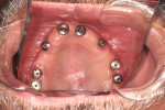 View of the healing abutments 4 weeks after implant exposure.