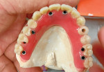 Occlusal view of the screw-retained acrylic full-arch interim hybrid prosthesis that was fabricated based on the full-arch provisional denture and an open tray impression of the implants.