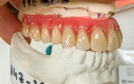 Lateral view of the screw-retained acrylic full-arch interim hybrid prosthesis on the master model.