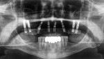 Radiograph taken to verify seating of the interim hybrid prosthesis, which would be worn for a period of 3 weeks to verify occlusion, function, and esthetics before fabrication of the final zirconia prosthesis. The lower missing incisors have been replaced with a fixed, 6-unit tooth-borne bridge.