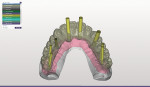Occlusal view of the virtual planning of the screw-retained zirconia hybrid prosthesis showing the projected angulation of the screw access channels in nonesthetic areas.