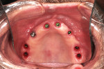 View of the soft tissue following the removal of the acrylic hybrid prosthesis, demonstrating a healthy noninflamed gingival cuff at each implant site.