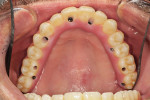 The zirconia hybrid prosthesis seated on the maxillary arch with fixation screws torqued to the manufacturer’s recommended value.