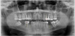 Preoperative panoramic radiograph of the patient, demonstrating the existing root canal treatments, missing teeth, and a lower right molar with an apical radiolucency.