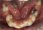 Mandibular occlusal view of the molar tubes that were attached before the fixed orthodontic treatment was performed. Note the crowding of the lower anterior teeth.