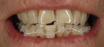 Orthodontic work on the day of placement, demonstrating the ceramic brackets and coated nickel-titanium archwire that was used.