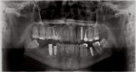 Panoramic radiograph taken to assess the implants and surrounding structures after 4 months of healing.