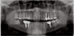 Postoperative panoramic radiograph demonstrating the completed restorations.