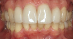 Four-year postoperative retracted smile photograph, demonstrating healthy and stable soft tissue.