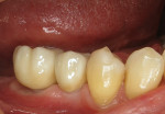 Implant crowns at site Nos. 29 and 30. Note the thick band of keratinized tissue that formed after the connective tissue grafts were placed.