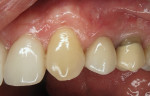 Left lateral view of the veneer on tooth No. 10 and the implant crown at site No. 12.