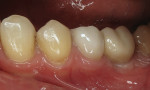 Left lateral view of the full-coverage crown on tooth No. 20 and the implant crown at site No. 19.