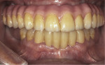 Retracted facial view of the patient, showing the maxillary monolithic zirconia hybrid prosthesis in proper occlusion with the lower arch.