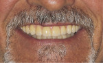 Final smile photograph demonstrating a natural-looking and esthetic result.
