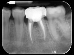 Fig 1. Pretreatment periapical radiograph of tooth No. 19.