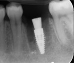 Fig 4. Periapical radiograph immediately post-implant placement.