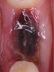 Fig 6. Healing of the surgical site at day 2.