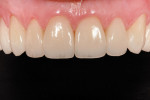 Figure 2  A 10-unit daVinci veneer case on teeth Nos. 4 through 13, courtesy of Dr. Sheraz Aleem (London, UK) AACD Dentist.