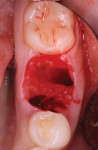 Fig 2. Extraction socket with intact buccal and lingual plates and septal bone.