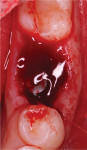 Fig 3. Implant placement with initial blood clot.