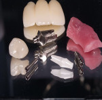 Figure 3  State-of-the-art technology, patient-satisfying function and exquisite artistry come together for a simplified implant solution. daVinci Dental Studio’s Implant Solutions<sup>TM</sup> (DVIS<sup>TM</sup>) combines all elements of an im