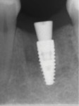 Fig 17. Periapical radiograph at 4 months.