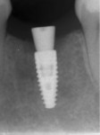 Fig 18. Periapical radiograph at 6 months.