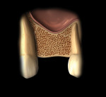 Fig 2. This posterior edentulous space has an initial vertical height of less than 10 mm coronal to the maxillary sinus.