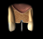 Fig 3. Initial penetration of the cortical bone is performed with a round bur.