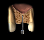Fig 4. A pilot drill or the first expander drill may be used to initiate the osteotomy. In bone with type IV density, as often seen in the posterior maxilla, use of the first expander drill is suggested. Here, the first expander drill is used to start and deepen the osteotomy preparation to within 1 mm below the sinus floor. A check radiograph then is recommended to confirm that the sinus has not been penetrated.