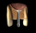Fig 10. The bone graft material, hydrated with sterile water, is then placed into the osteotomy and moved apically with the #4 expander drill at 75 rpm without irrigation. Initial penetration of the maxillary sinus with the bone graft contained within the Schneiderian membrane is depicted.