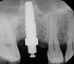 Fig 13. The radiograph of the final expander drill in place at the conclusion of sinus elevation demonstrated a dome of bone graft material surrounding the apex of the expander drill.