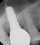 Fig 16. The periapical radiograph taken 3 years after restoration showed good bone support around the implant.